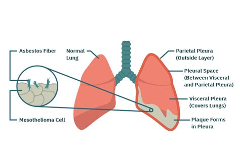 Pleural Mesothelioma | Treatment, Prognosis & Diagnosis