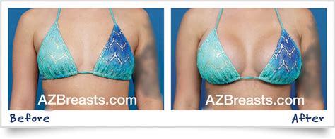 How To Choose Breast Implant Size - Ademploy19