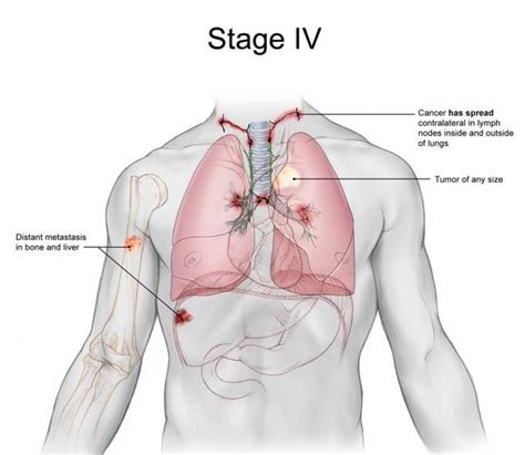 Last-Stage Lung Cancer: Sign, Treatment and Life Expectancy | New Health Advisor