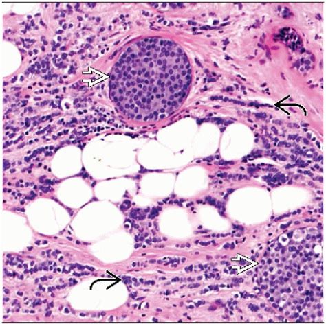 Invasive Lobular Carcinoma Ultrasound