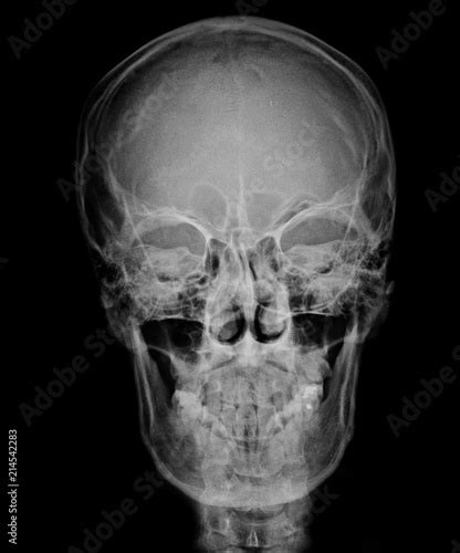 head skull x-ray front view | Buy Photos | AP Images | DetailView