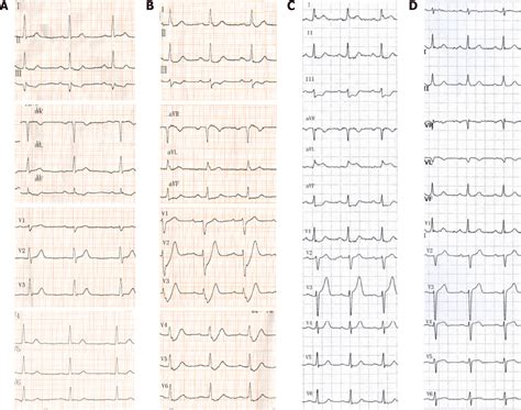 Figure 1 from De Winter syndrome and ST-segment elevation myocardial ...