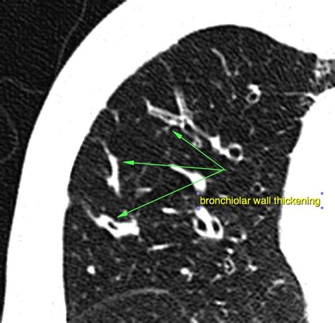 Bronchiolitis CT scan - wikidoc