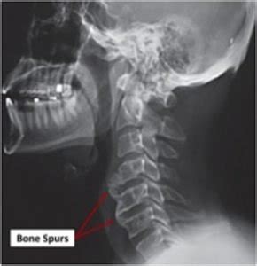 Bone Spurs Treatment - New Jersey - Centers for Neurosurgery, Spine & Orthopedics