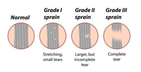 Hip Flexor Strain, its causes and treatment | Jugaadin News