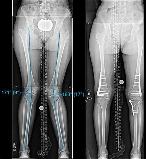 Can Knock Knees Be Corrected in Adults? | HSS