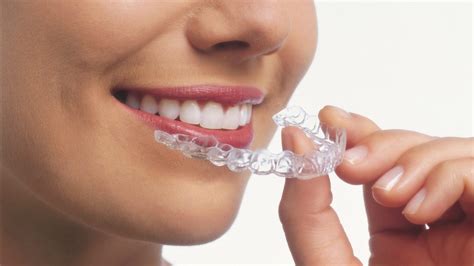 Clear Aligner FAQs - NoVA Orthodontics | Fairfax VA