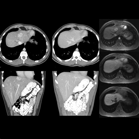 focal nodular hyperplasia | pacs