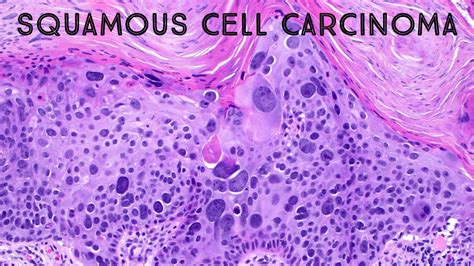 Squamous cell carcinoma in situ with massive pleomorphism (pathology ...