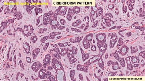 CRIBRIFORM PATTERN : #patternsinhistopathology - Pathology Made Simple