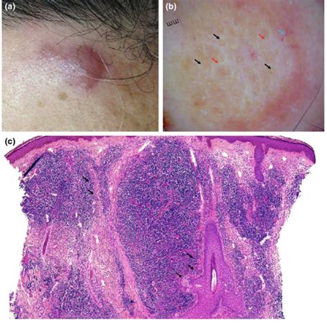 (a) Clinical picture of a primary cutaneous follicle center lymphoma... | Download Scientific ...