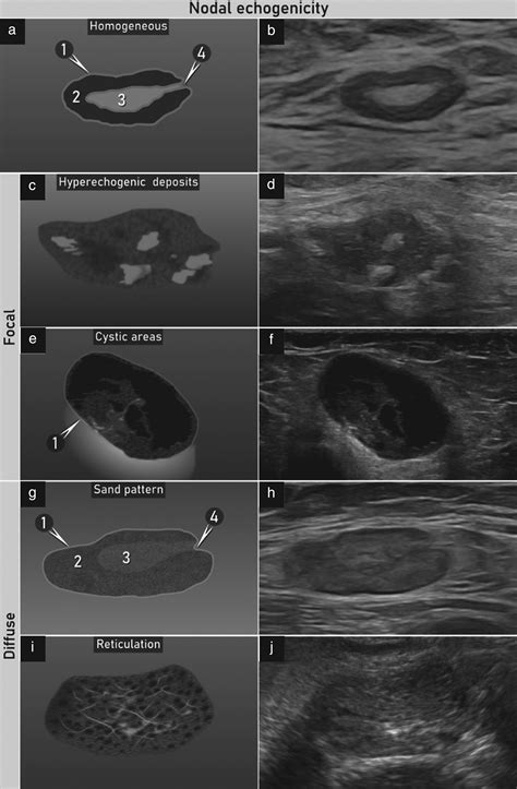 Swollen Lymph Nodes In The Groin Metromale Clinic Fertility, 58% OFF