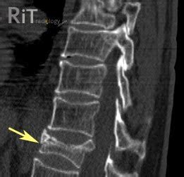 RiT radiology: Vertebral Burst Fracture