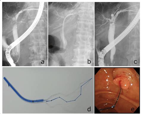 Procedure of endoscopic treatment for biliary stricture. a ...