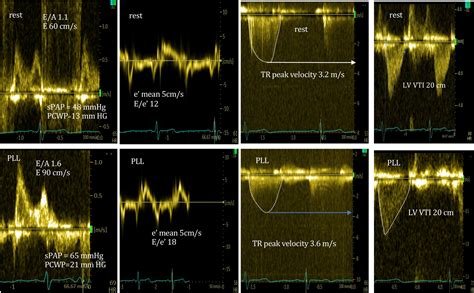 Diastolic function assessment by echocardiography: A practical manual for clinical use and ...