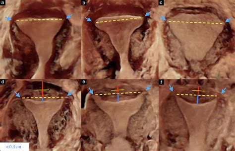 Septate uterus according to ESHRE/ESGE, ASRM and CUME definitions: association with infertility ...