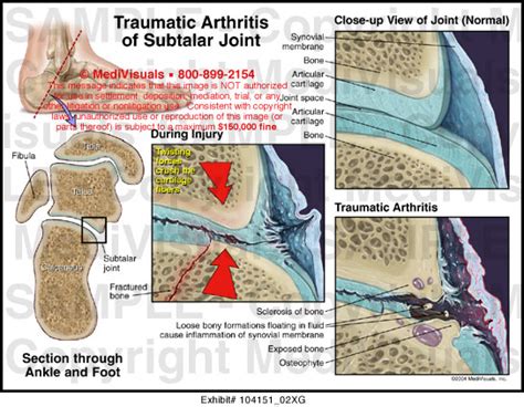 Traumatic Arthritis of Subtalar Joint Medical Exhibit Medivisuals