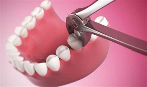 Tooth Extraction: Understanding the Procedure and Aftercare