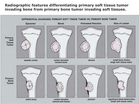 PPT - Primary bone tumors presenter: ondari n.j FACILITATOr : prof ...