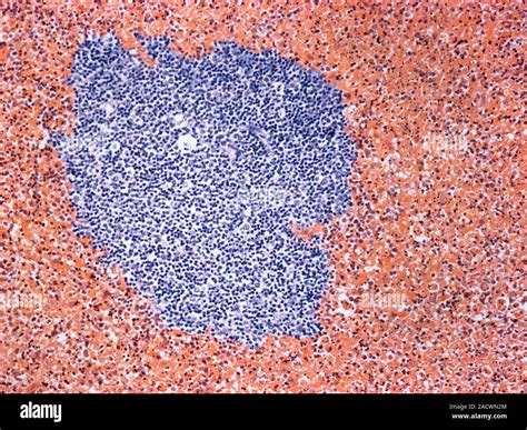 Kikuchi-Fujimoto disease. Light micrograph of a section through a lymph node of a patient with ...