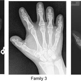 Summary of clinical features of Type A1 brachydactyly (BDA1) associated ...