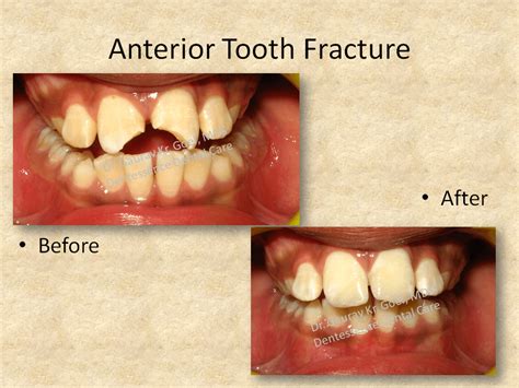 Anterior tooth Fracture- Composite - Dentessence Dental Care, Best Dental Clinic in Noida ...