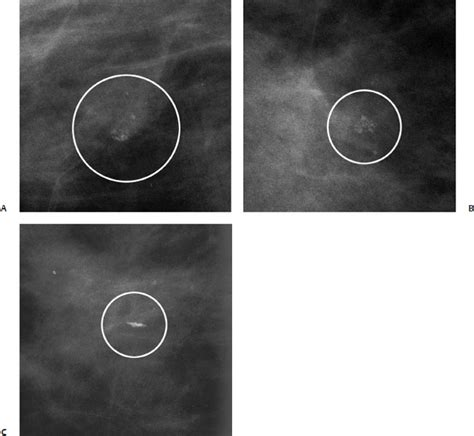 Milk Of Calcium Cyst Ultrasound