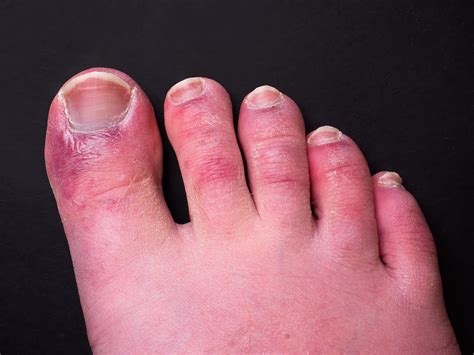 Painful, Red, Itching and Blistered Toes? It Might Be Chilblains | Foot & Ankle