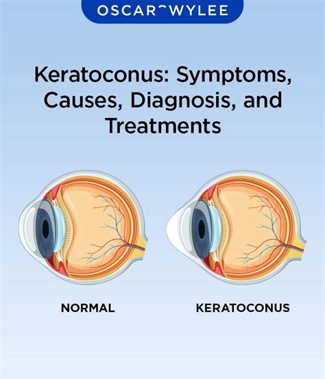 Keratoconus: Symptoms, Causes, Diagnosis, and Treatments