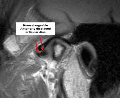 Diagnostic Imaging of the Temporomandibular Joint (TMJ) - Larry M ...