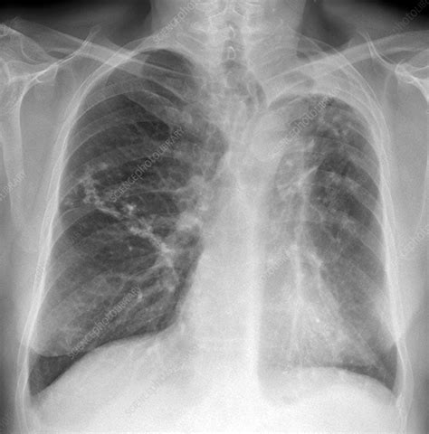 Tuberculosis Lung X Ray