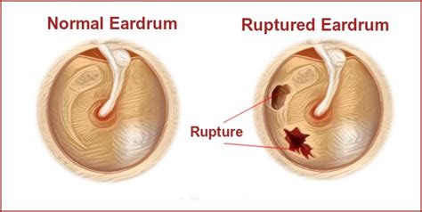 Ruptured Eardrum causes, symptoms and treatment