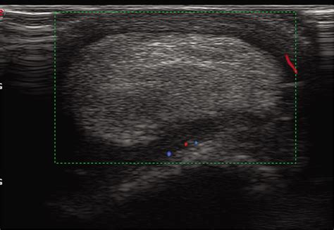 Lipoma Ultrasound Report Template | Sitelip.org