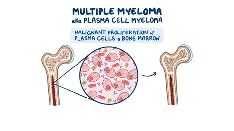 Plasma Cell In Multiple Myeloma