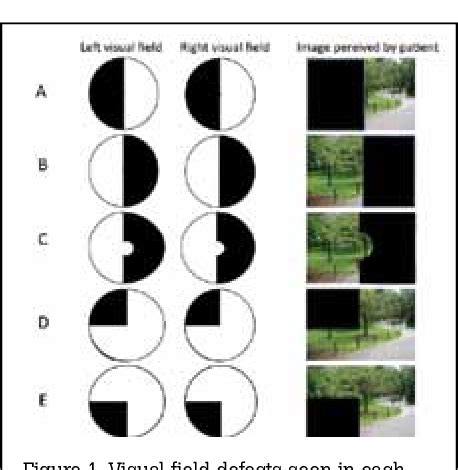 Figure 1 from Visual field defects after stroke--a practical guide for ...