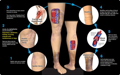 Leg Ulcers - Infection - Varicose Veins - Alsara Vein Clinic