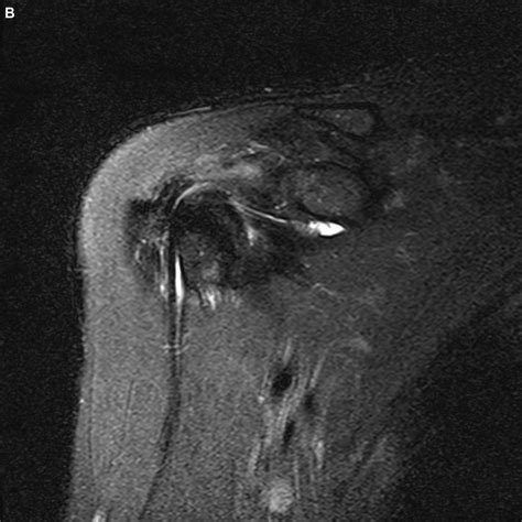 Arthroscopic image of a partial long head of biceps tendon tear (A),... | Download Scientific ...