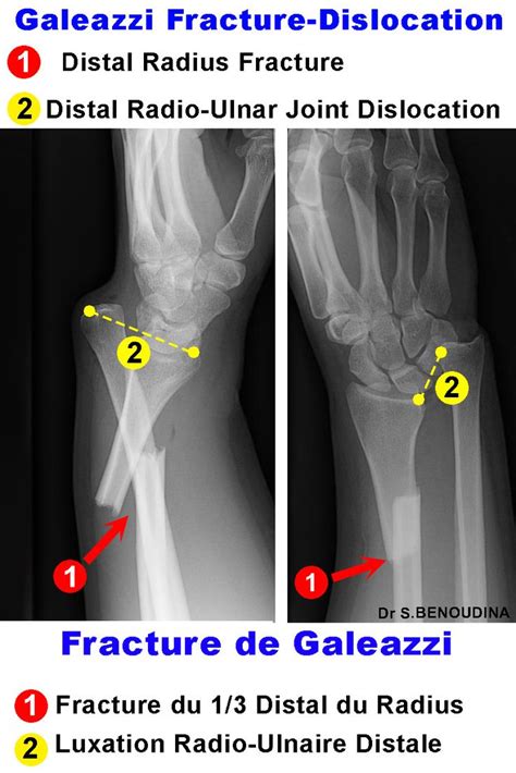 Galeazzi Fracture Dislocation | Radiología, Fracturas, Radiografia