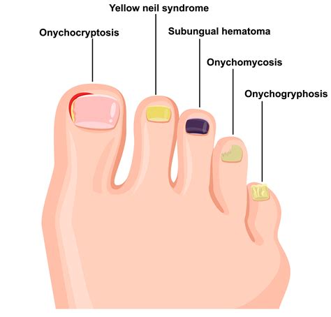 Common Nail Diseases