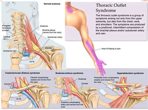 Cervical Rib(Thoracic Outlet Syndrome):Overview,Diagnosis & Treatment » How To Relief