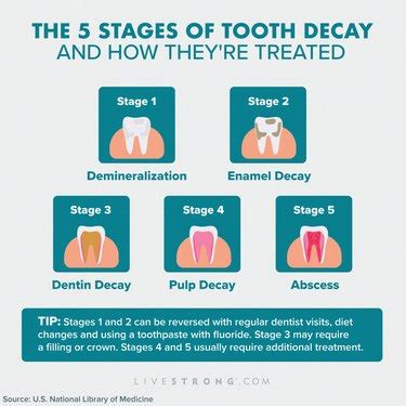 Tooth Decay: Stages, Causes, Treatment and Prevention | livestrong