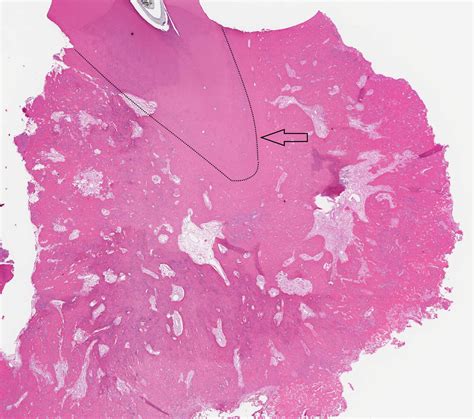 Cementoblastoma Histology