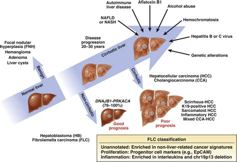 Fibrolamellar Hepatocellular Carcinoma: A Rare but Distinct Type of Liver Cancer - Gastroenterology