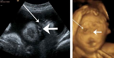 Holoprosencephaly On Ultrasound