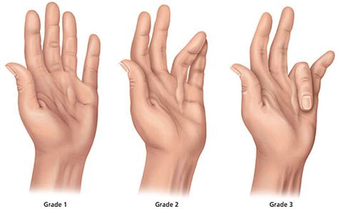 Dupuytren's Contracture - Causes, Symptoms, Treatment