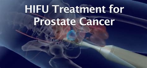 HIFU therapy for prostate cancer in Mesa,Arizona - East Valley Urology ...