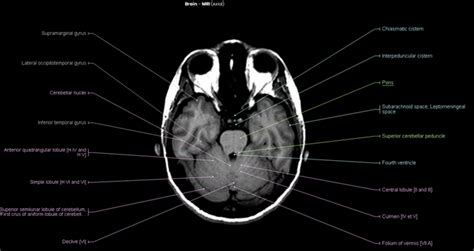 Brain MRI - NeurologyNeeds.com