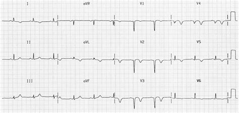 Poor R Wave Progression (PRWP) • LITFL • ECG Library Diagnosis