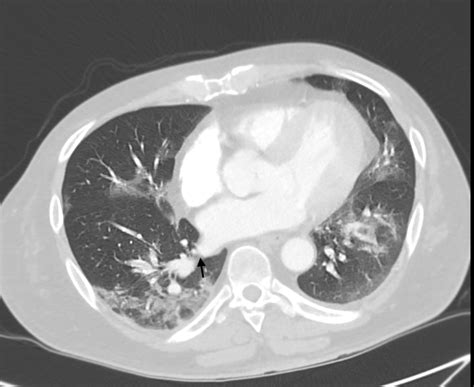 Cureus | Acute Pulmonary Embolism in COVID-19: A Report of Two Cases