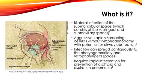 Ludwig's Angina — learnED